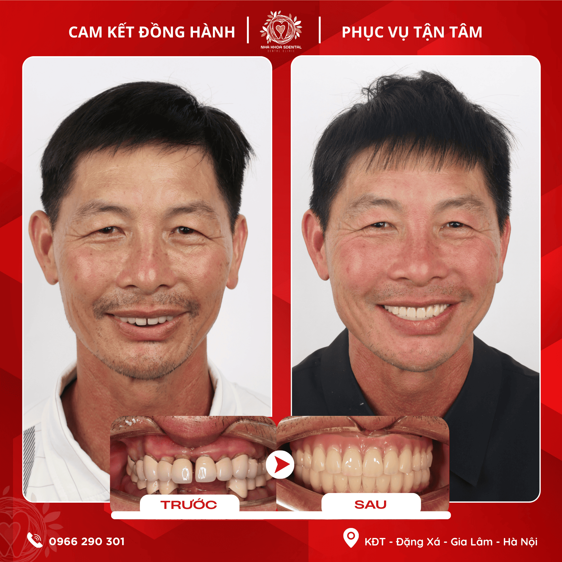 Cấy Ghép Implant Toàn Hàm: Chú Nguyễn Thế Dân (1974) Và Hành Trình Tìm Lại Nụ Cười Tại S-Dental